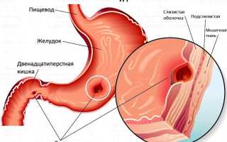 Лучшие народные средства для лечения язвы желудка