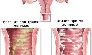 Вульвовагинит  у девочек  и  влагалищный  рефлюкс  уретры