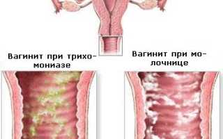 Вульвовагинит  у девочек  и  влагалищный  рефлюкс  уретры