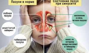 Не просто насморк: верхнечелюстной синусит