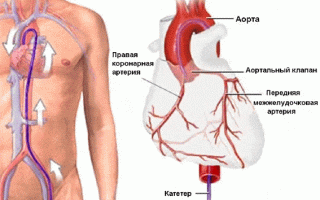 Коронарография – современный метод исследования