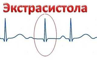 Электросистолы сердца: причины и лечение