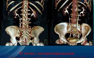 Что такое КТ с контрастом и при каких почечных патологиях применяют метод