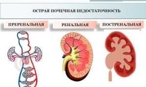 Острая недостаточность почек: как справляться с болезнью