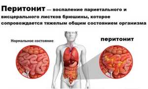 Перитонит — причины, симптомы и лечение