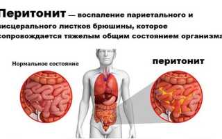 Перитонит — причины, симптомы и лечение