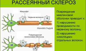 Сила диеты, или Как улучшить состояние при рассеянном склерозе