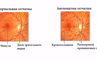 Ангиопатия сетчатки глаза: как уберечь зрение?