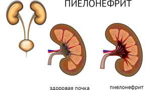 Фитотерапия — эффективный способ лечения пиелонефрита