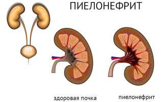 Фитотерапия — эффективный способ лечения пиелонефрита