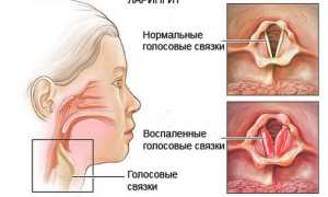 Что такое стенозирующий ларингит и как правильно его лечить