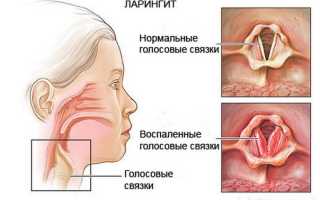Что такое стенозирующий ларингит и как правильно его лечить