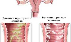 Хронический вагинит: факторы развития, симптомы и методы лечения