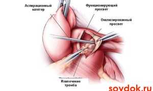 Лечебные мероприятия при тромбоэмболии легочной артерии