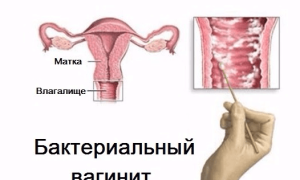 Бактериальный вагинит: причины, симптомы и лечение