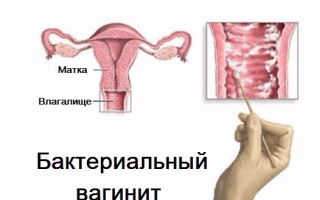 Бактериальный вагинит: причины, симптомы и лечение