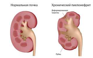 Хронический пиелонефрит: особенности симптомов и лечения