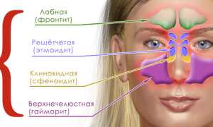 Как понять, что у вас гайморит?