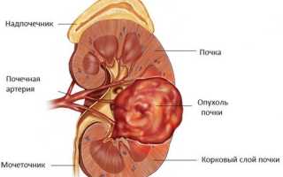 Метастазирующий рак почки: как жить с диагнозом