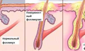 Фолликулит — опасное осложнение неправильной депиляции
