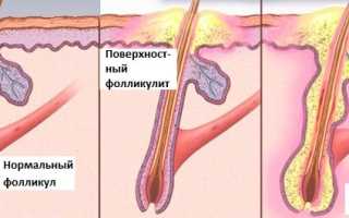 Фолликулит — опасное осложнение неправильной депиляции