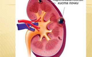 Лечение кисты почки народными средствами или как воспользоваться силой природы