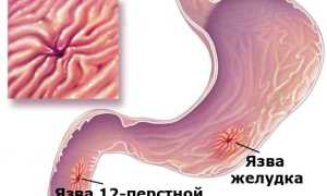 Патогенетические особенности  язвенной болезни желудка  и двенадцатиперстной кишки