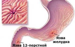 Патогенетические особенности  язвенной болезни желудка  и двенадцатиперстной кишки