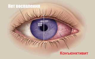 Бактериальный конъюнктивит: симптомы, диагностика, лечение