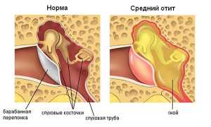 Гнойный отит у ребёнка: как не запустить опасное заболевание