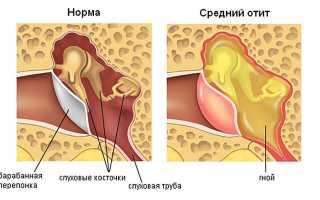 Гнойный отит у ребёнка: как не запустить опасное заболевание