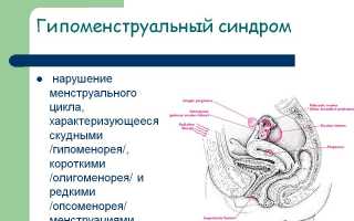 Олигоменорея — коварная женская патология