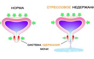 Стрессовое недержание мочи: способы лечения деликатной проблемы