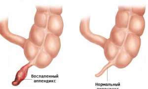 Болит живот: «воспаление хитрости» или аппендицит?