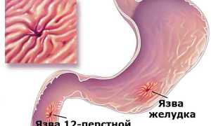 Язва двенадцатипёрстной кишки — как организм сигнализирует о недуге