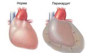 Перикардит: симптомы различных видов заболевания, диагностика и лечение