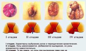 Неотложная помощь при геморрое. Лечение и профилактика