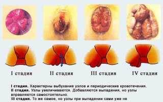 Неотложная помощь при геморрое. Лечение и профилактика