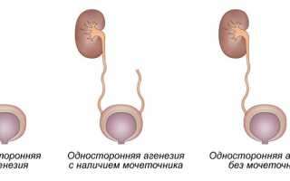 Врождённое отсутствие почки: фатально или нормально?