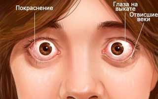 На стыке офтальмологии и эндокринологии: эндокринная офтальмопатия