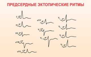 Эктопический предсердный ритм