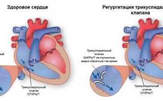 Трикуспидальная регургитация – порок сердца
