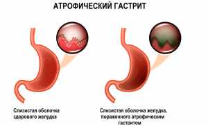 Атрофический гастрит симптомы