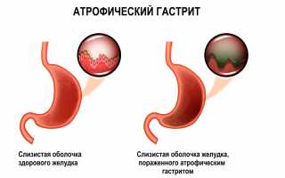 Атрофический гастрит симптомы
