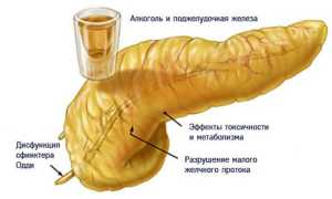 Влияние алкоголя на поджелудочную железу при панкреатите