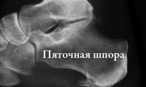 Димексид при пяточной шпоре: рекомендации и рецепты