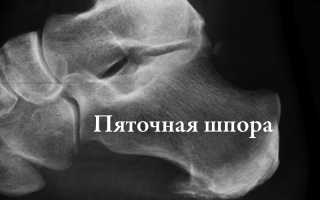 Димексид при пяточной шпоре: рекомендации и рецепты