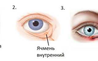 Ячмень на глазу: причины появления и эффективные меры профилактики