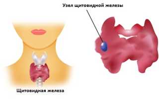 Узлы щитовидной железы и методы их оперативного лечения