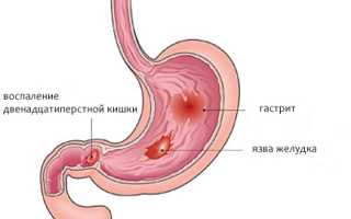 Бульбит двенадцатипёрстной кишки: классификация, причины, симптомы, диагностика и лечение
